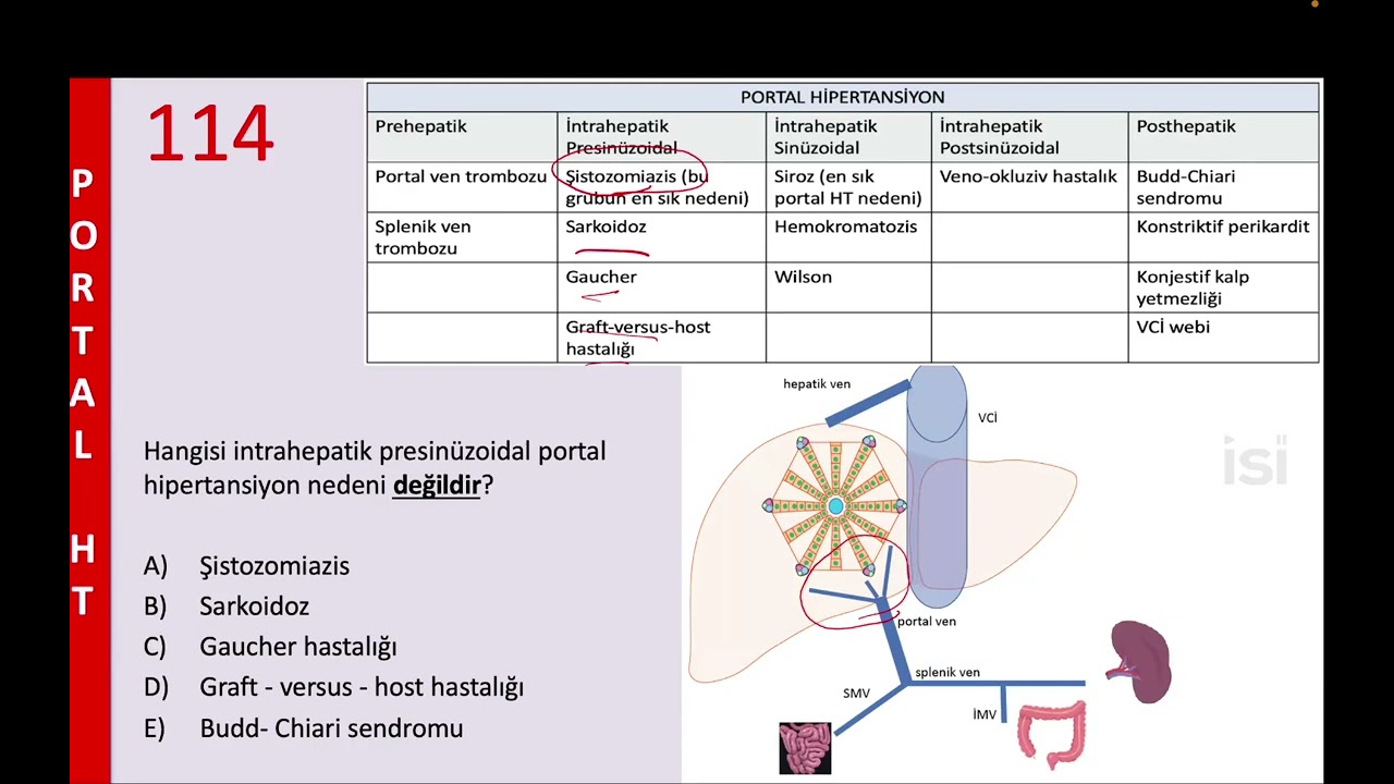 Posthepatik Portal Hipertansiyon Sorusu Referansımız ‘Soru Kampı’