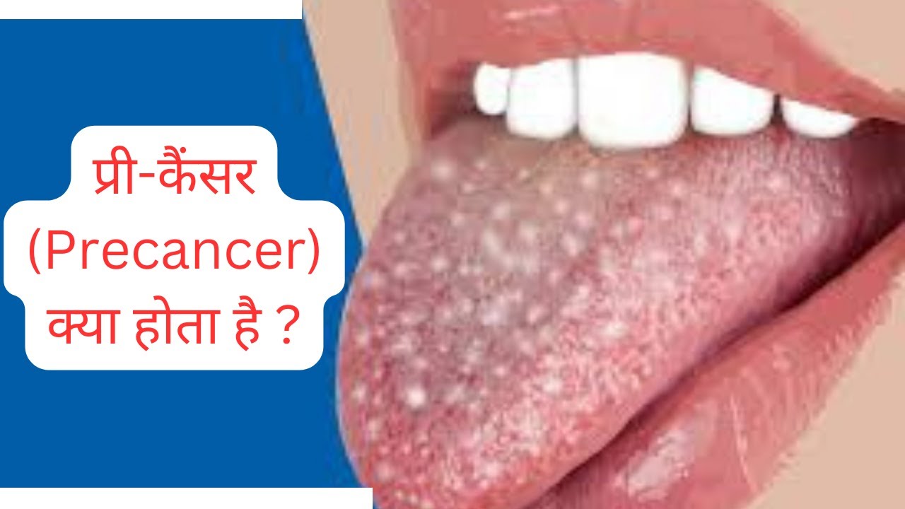 प्री-कैंसर (Precancer) क्या होता है ? क्या इसे रोक सकते हैं ? #centerofdentaltreatment #mouthcancer