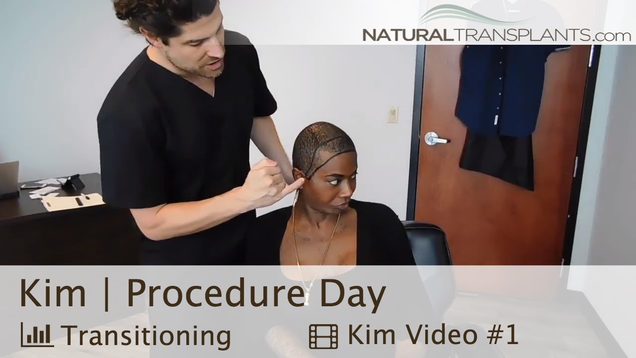 Transgender Hair Transplant | Transgender Hairline Surgery (Kim)