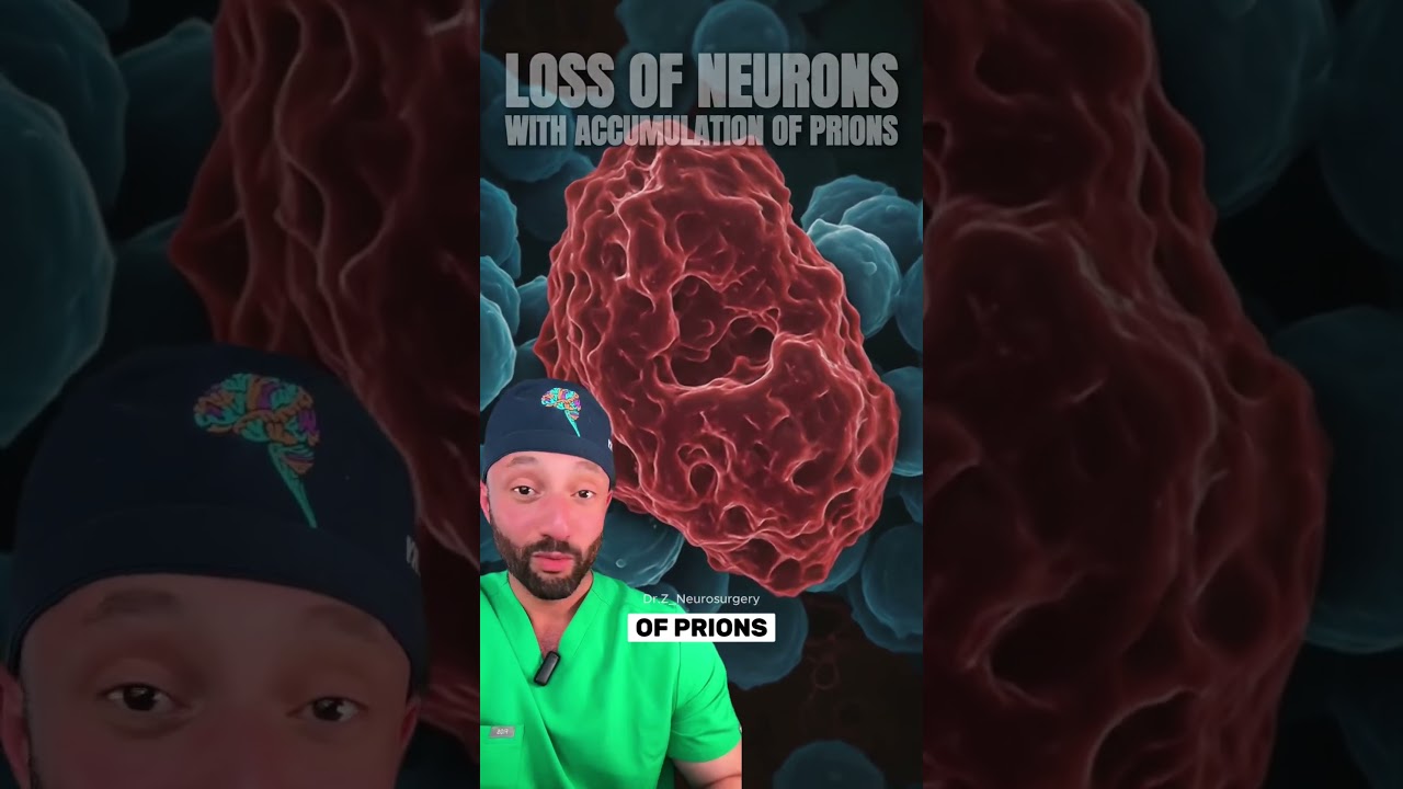 Here is how mad cow disease (bovine spongiform encephalopathy) looks like in a human. #medical