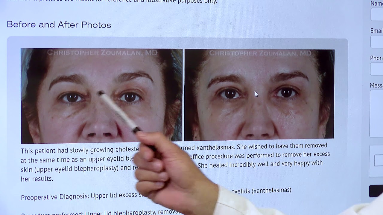 Benign Eyelid Lesions Beverly Hills