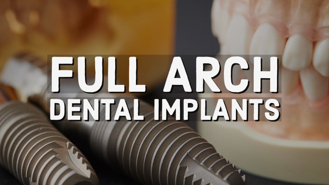 Full Arch Dental Implants
