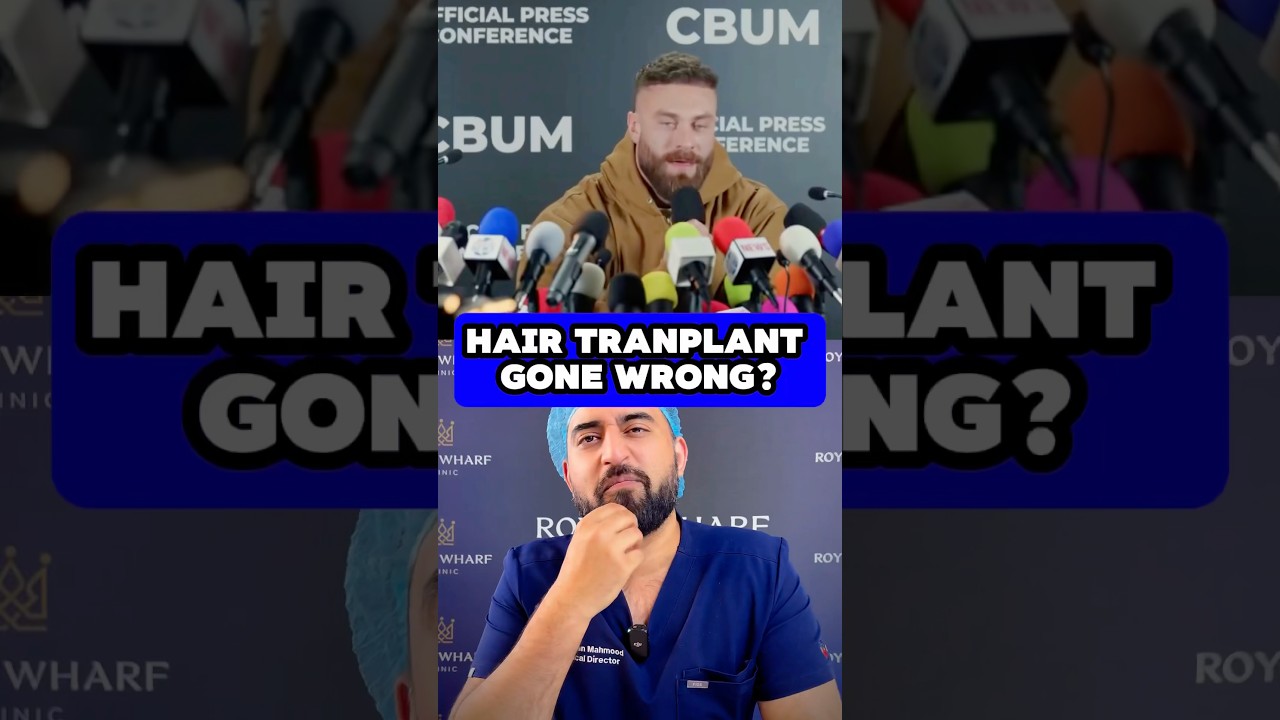 Chris Bumsteads Hair Transplant #hairtransplant
