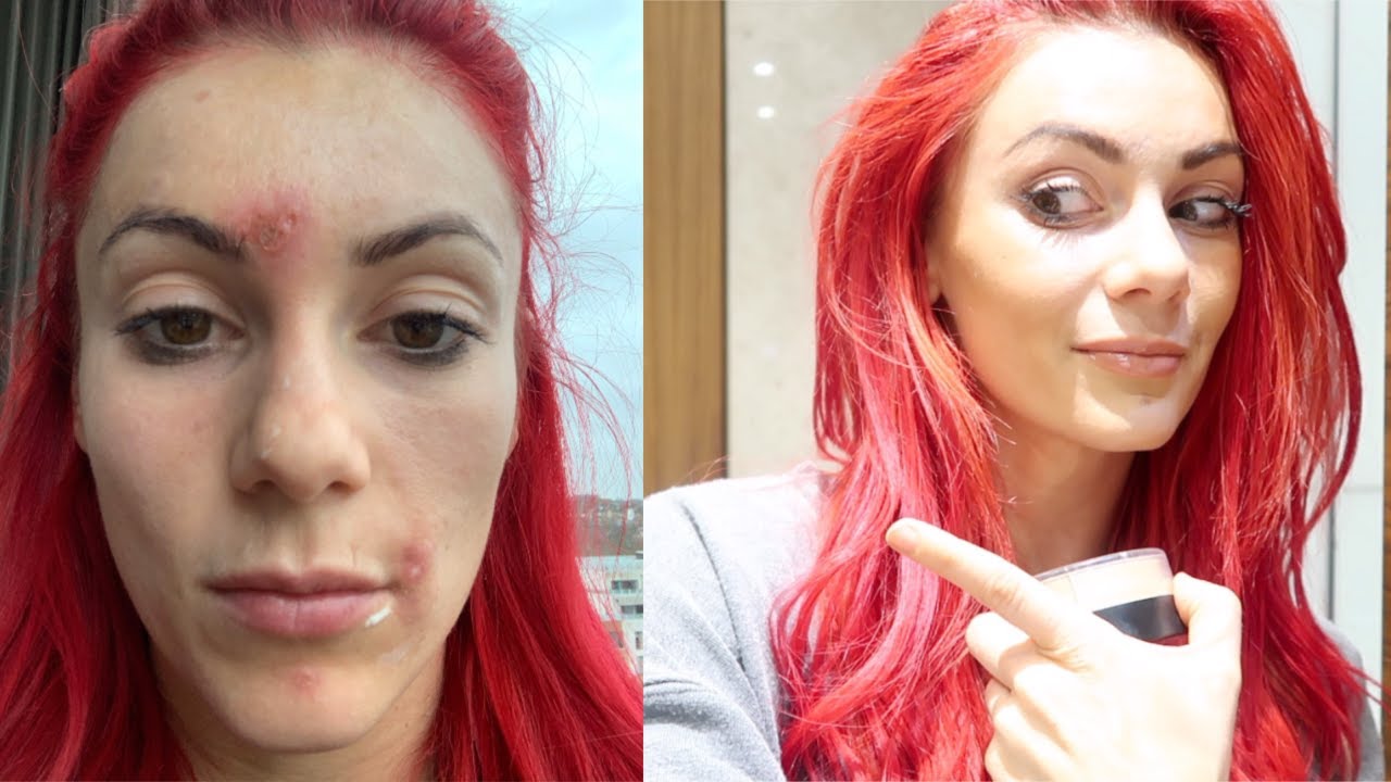 The Truth about my skin