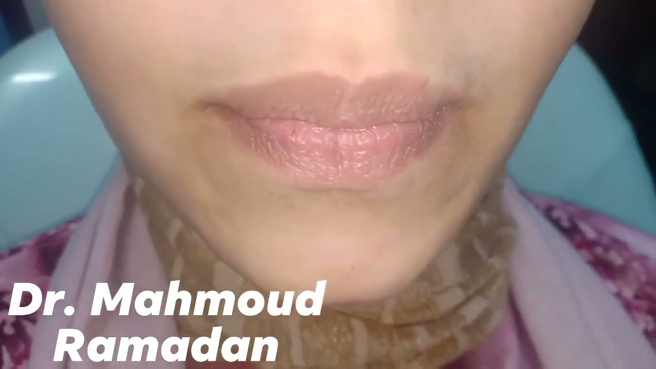 نها تحكى تجربتها عن الشفاء من الإنزلاق الغضروفى الدائم لمفصل الفك