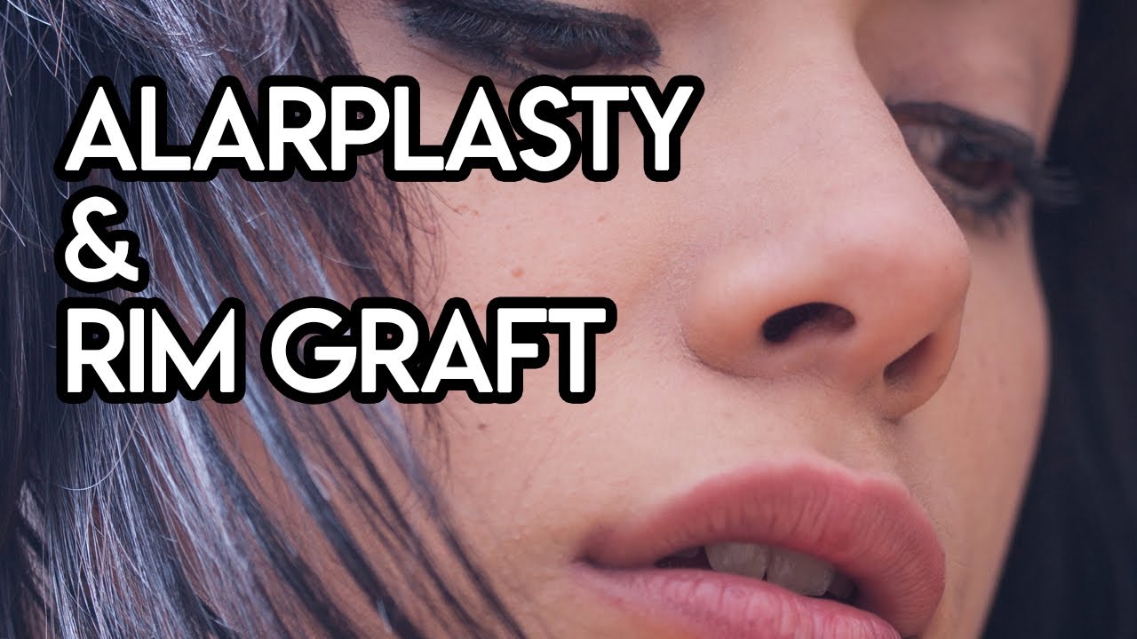 Alarplasty & Rim Graft