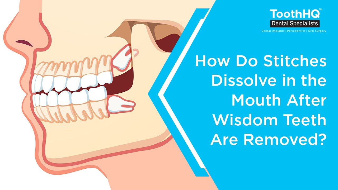 Do wisdom teeth stitches just fall out on their own?