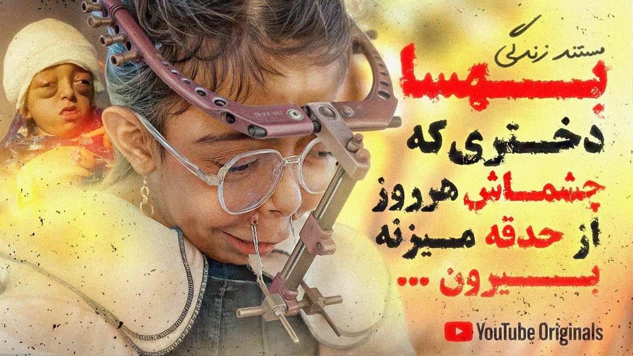 زندگی عجیب دختری که چشماش از حدقه میزنه بیرون💔
