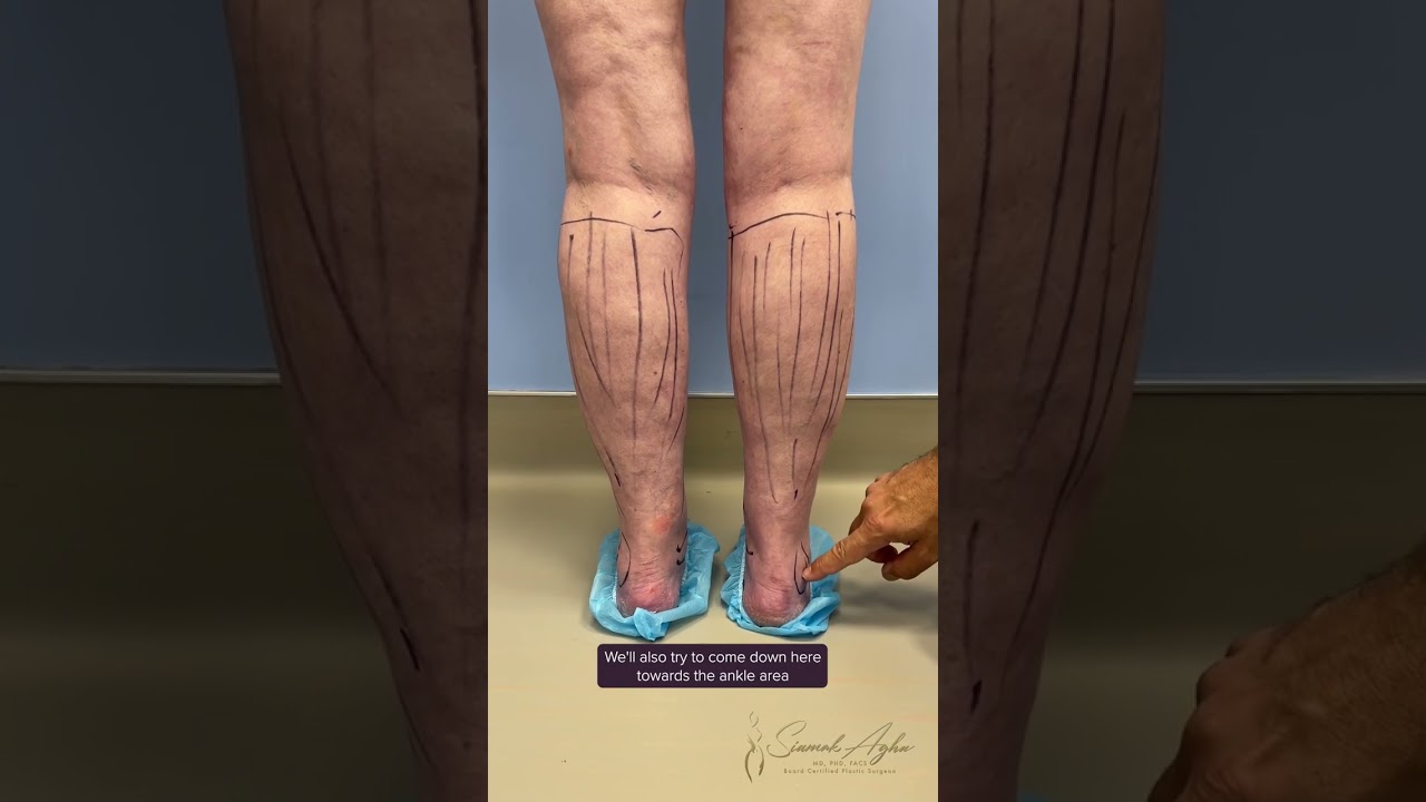 Part 1: Calf Vaser Liposuction and Forearm Reduction