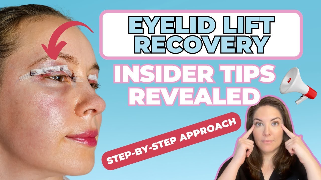The Step-by-Step Guide to Breezing Through Eyelid Surgery Recovery