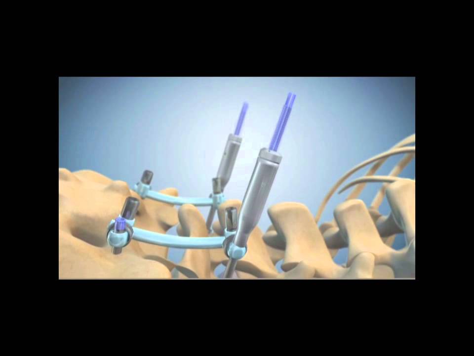 Spondylolisthesis Corrected with Medtronic's TSRH-3D instrumentation