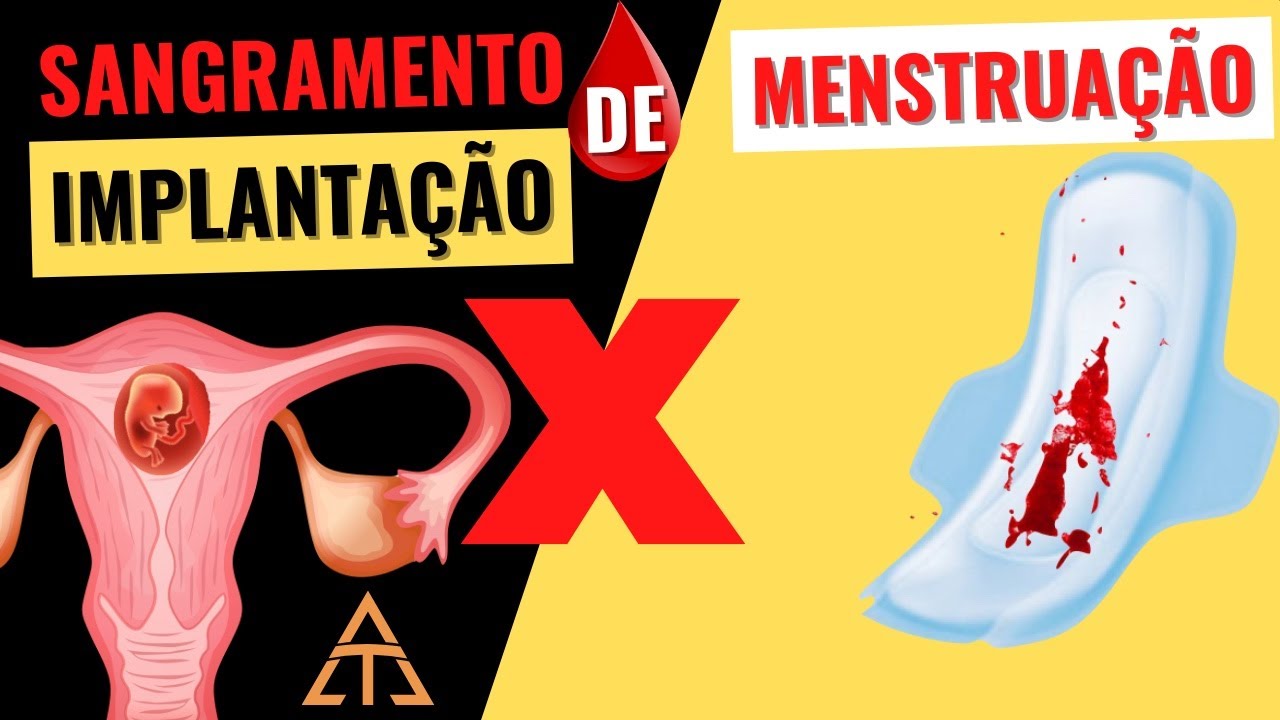 SANGRAMENTO DA IMPLANTAÇÃO DO EMBRIÃO (NIDAÇÃO) x MENSTRUAÇÃO: saiba como diferenciar!