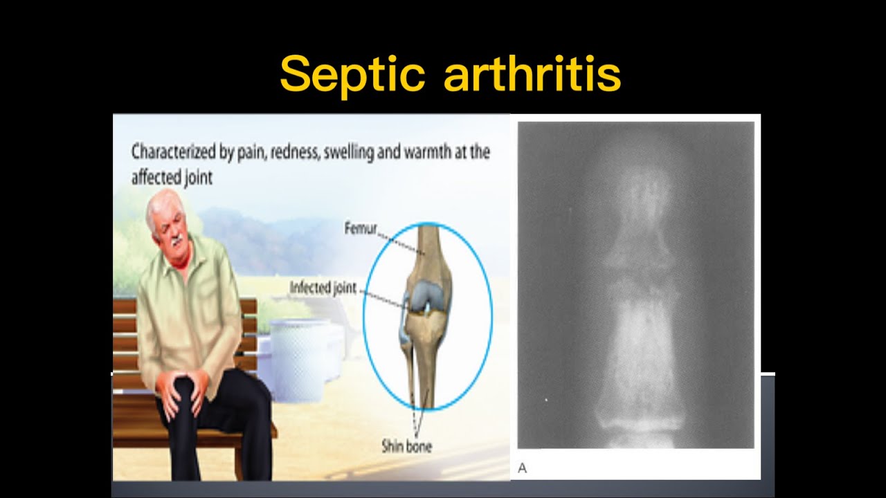 Septic arthritis