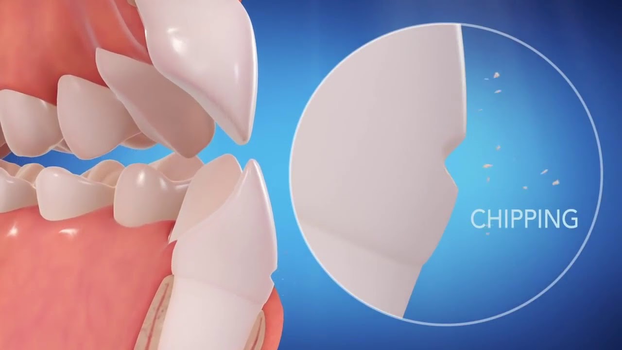 Invisalign & TMD