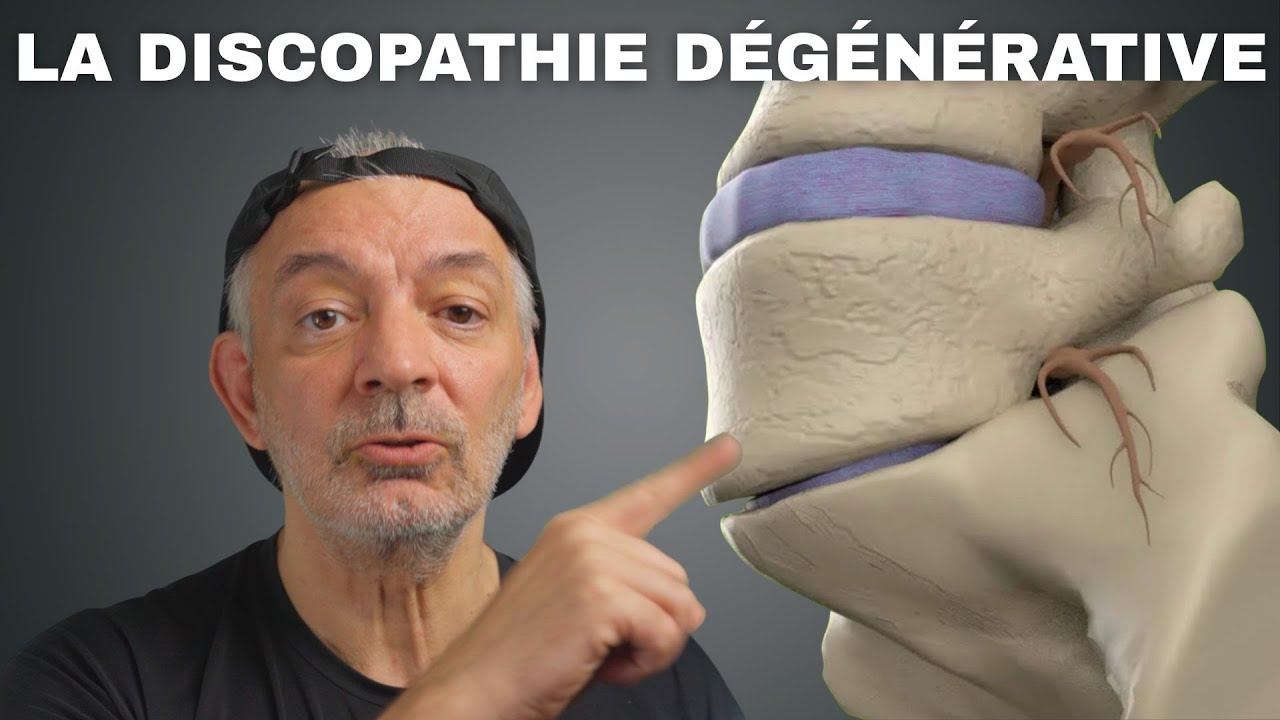 La Discopathie Dégénérative: Pourquoi j 'ai mal de dos?