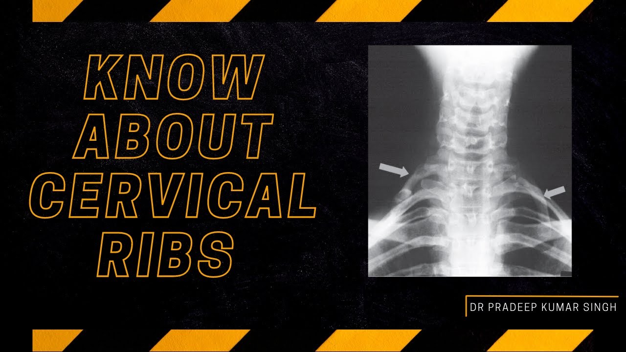 Know About Cervical Ribs/ Thoracic Outlet Syndrome /Dr. Pradeep Kumar Singh