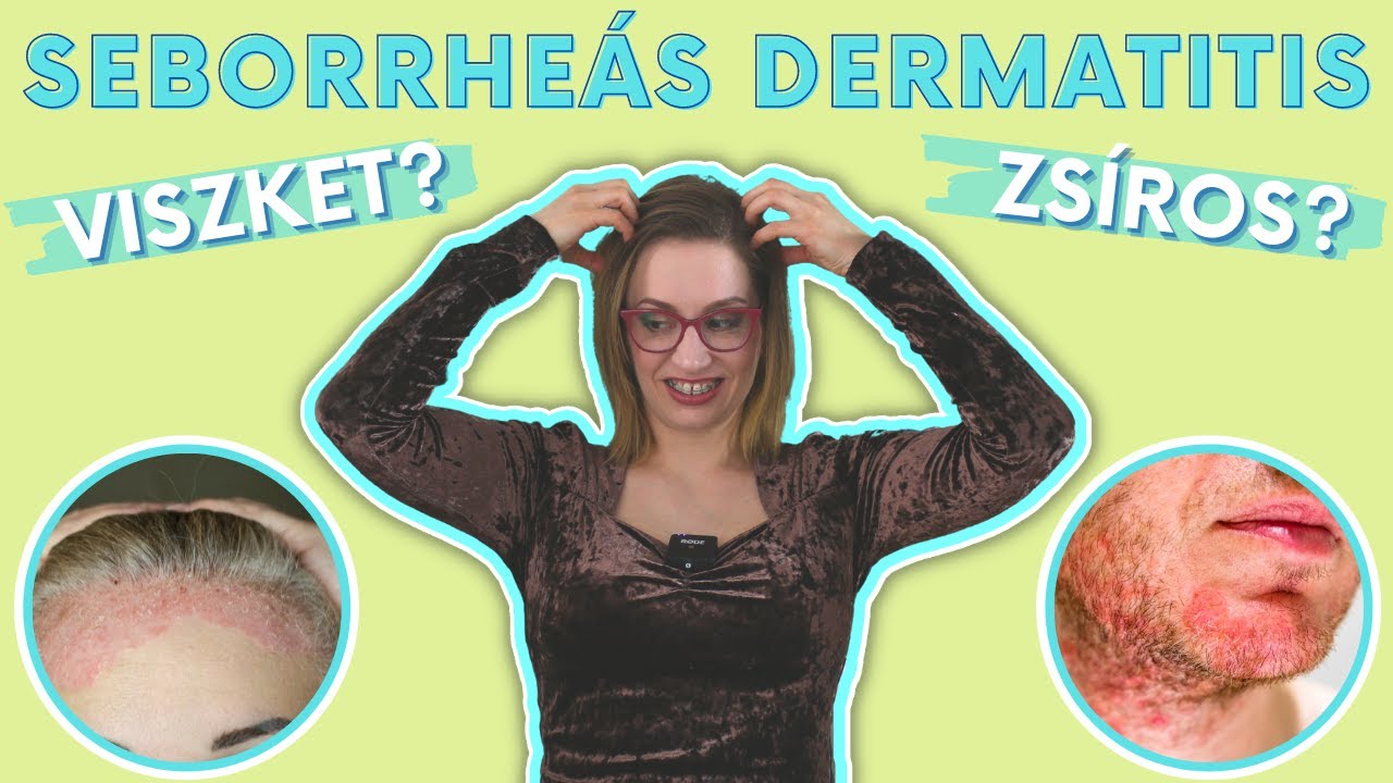 Seborrheás dermatitis