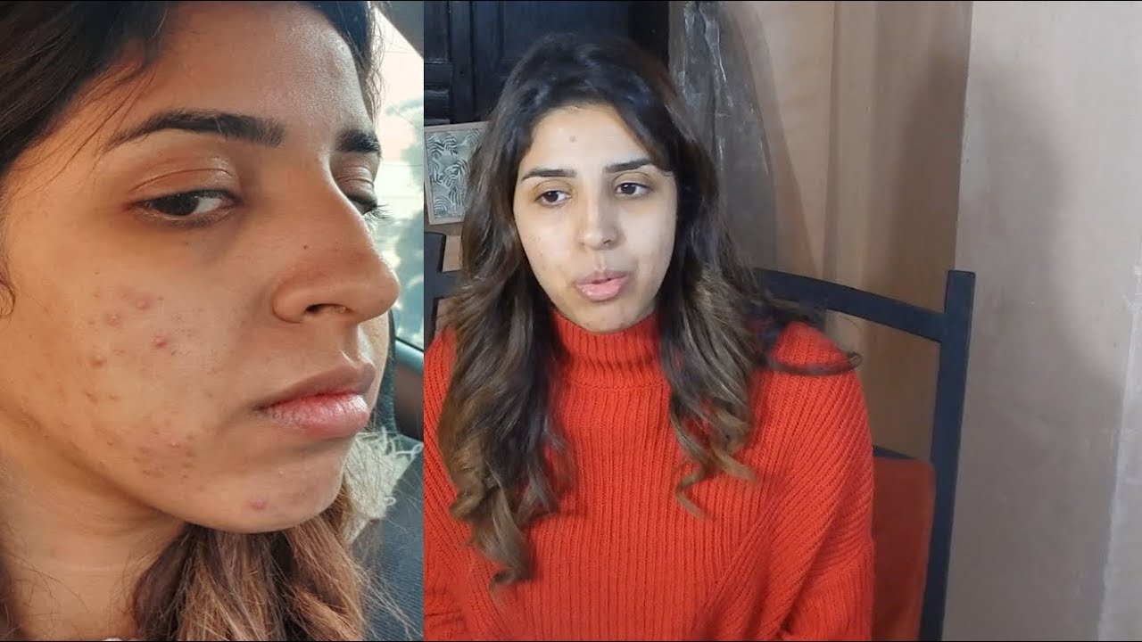 شهري الاول من كوراكني (اعراض)CURACNé
