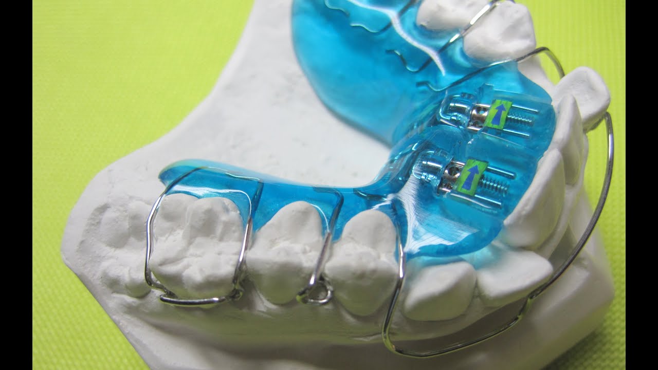 Dehnplatte 1/4 Zahnspange Schritt für Schritt Active Plate how to make Kieferorthopädie Orthodontics