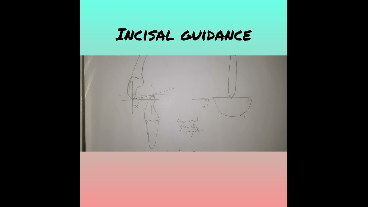 BALANCED OCCLUSION IN COMPLETE DENTURES