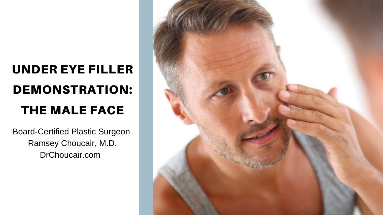 Dark Eye Circles in Men: Filler Demonstration-Part 1- by Plastic Surgeon, Ramsey Choucair, M.D.