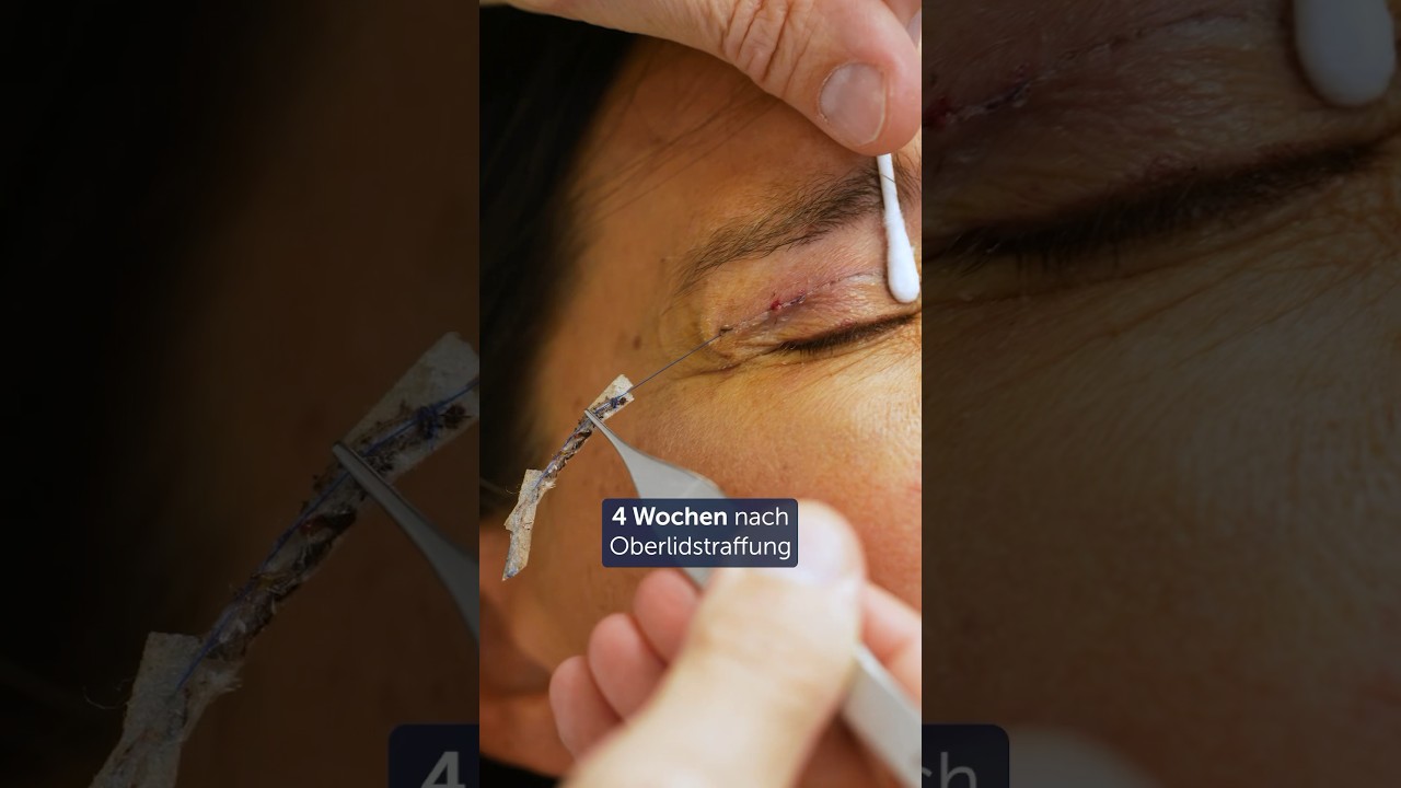 Oberlidstraffung nach 4 Wochen. 