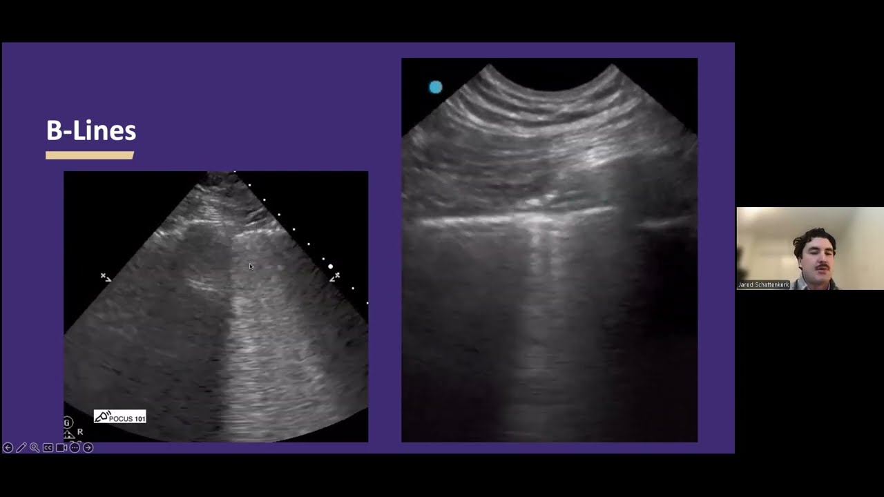 AHD POCUS 201 lung and cardiac point of care ultrasound J Shattenkerk