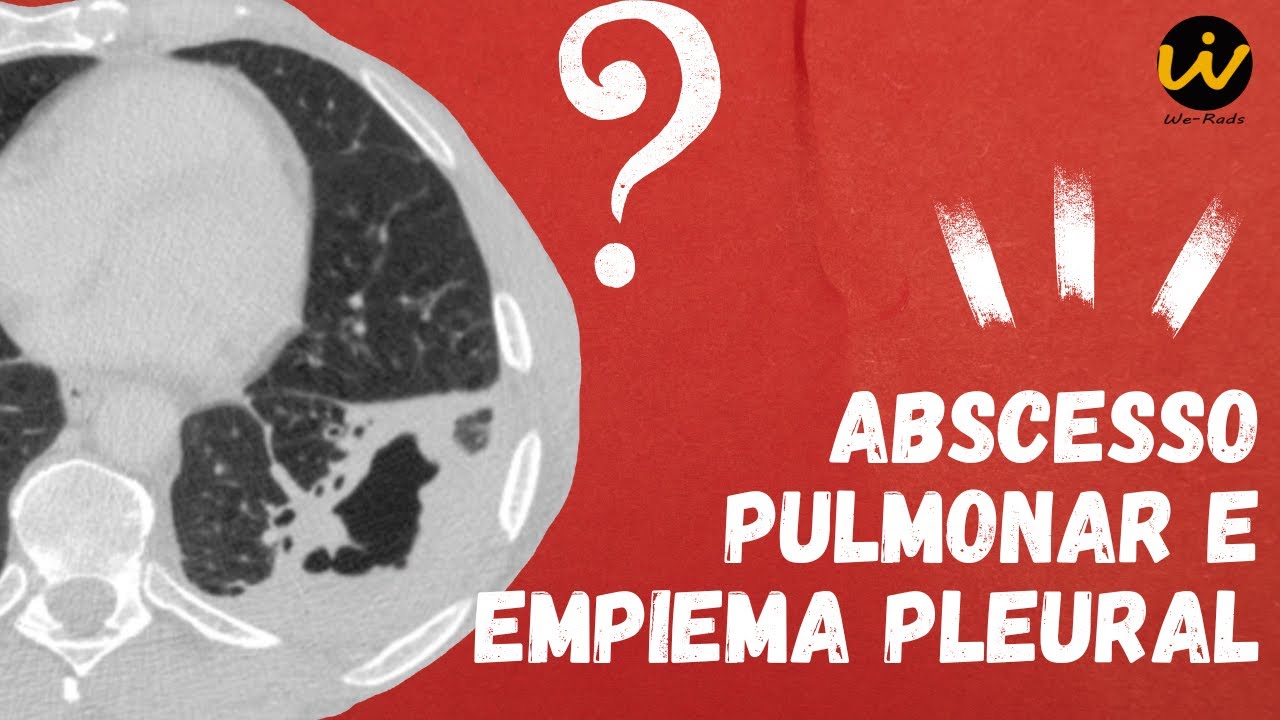 ABSCESSO PULMONAR e EMPIEMA PLEURAL - Tomografia de Tórax