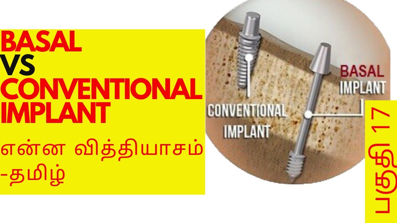 Basal Vs Conventional implant | Cost of full mouth basal implant in Chennai | Dr.MKP | SDC