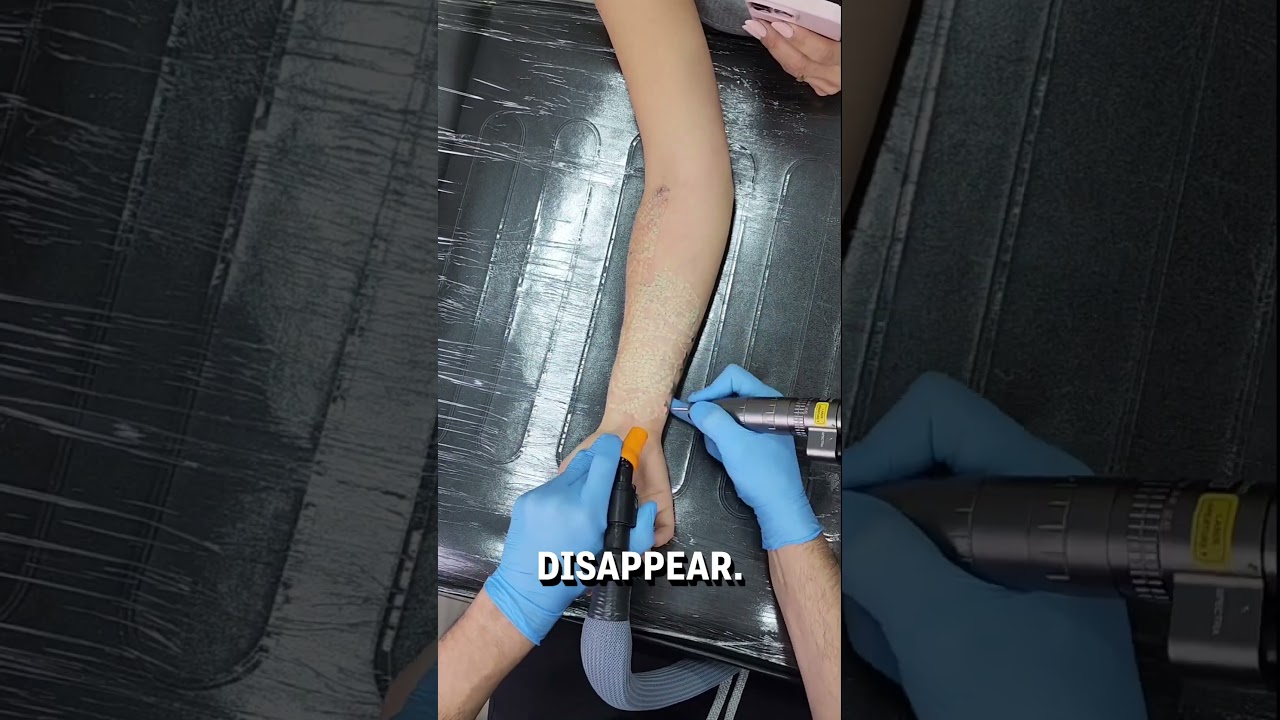 Laser tattoo removal of sleeve tattoo 😮👀  -  🎥 helltatto