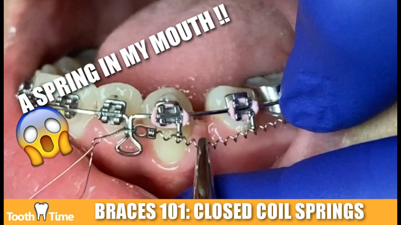 Braces in New Braunfels: Closed Coil Springs - Tooth time Family Dentistry
