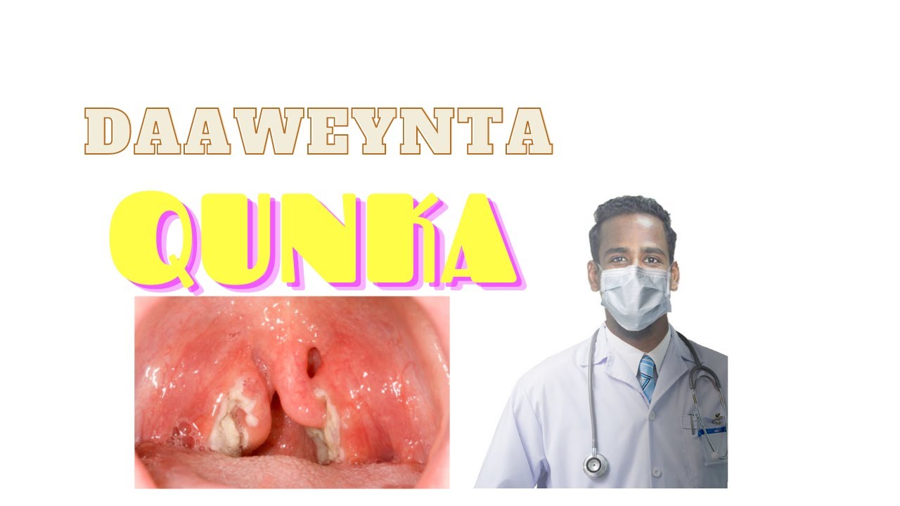 QUNKA. Daweeynta Qunka Tonsillitis