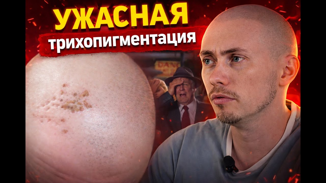 УЖАСНАЯ ТРИХОПИГМЕНТАЦИЯ / WORST ScalpMicropigmentation