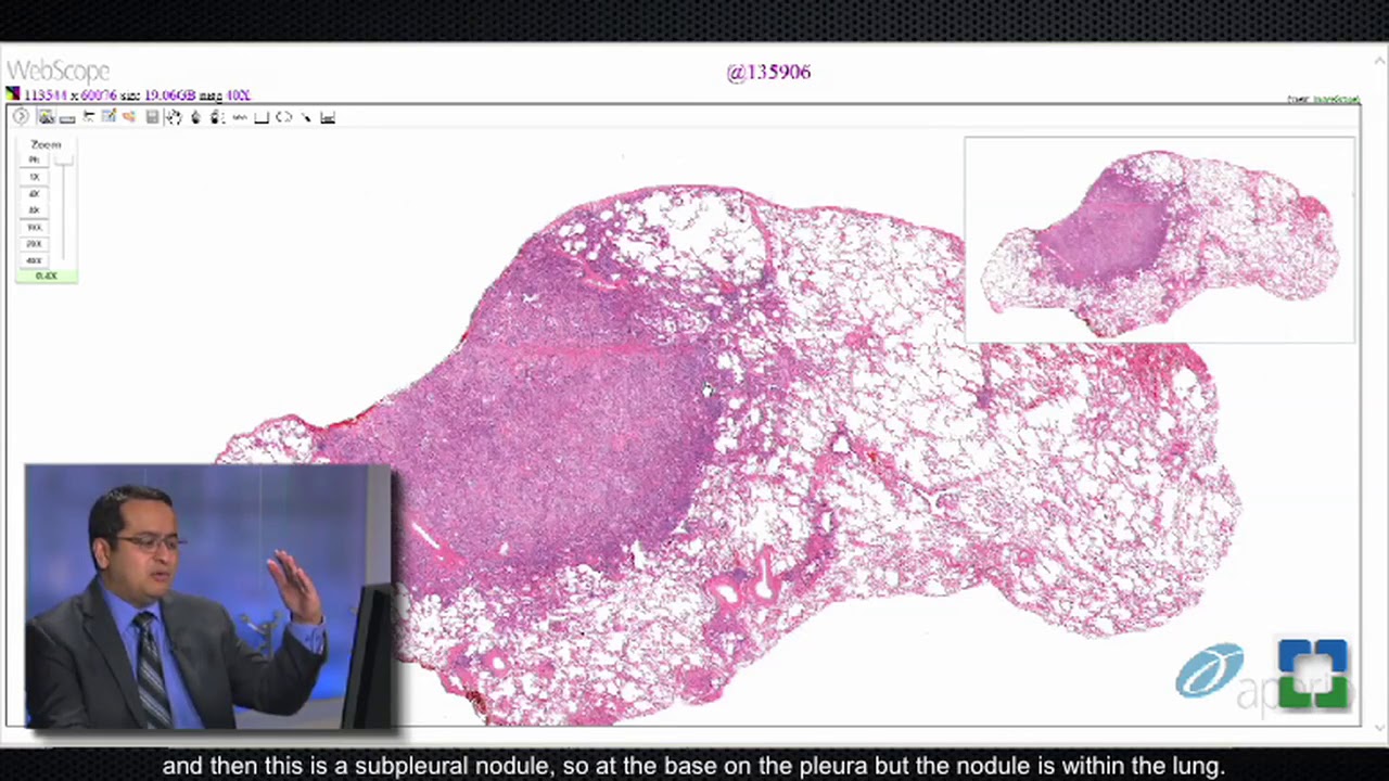 Lung Granulomas Caused by Fungal Infection