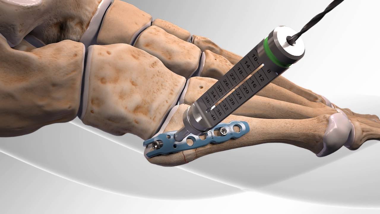 Metatarsal Fracture Repair with Arthrex&reg; Hook Plate