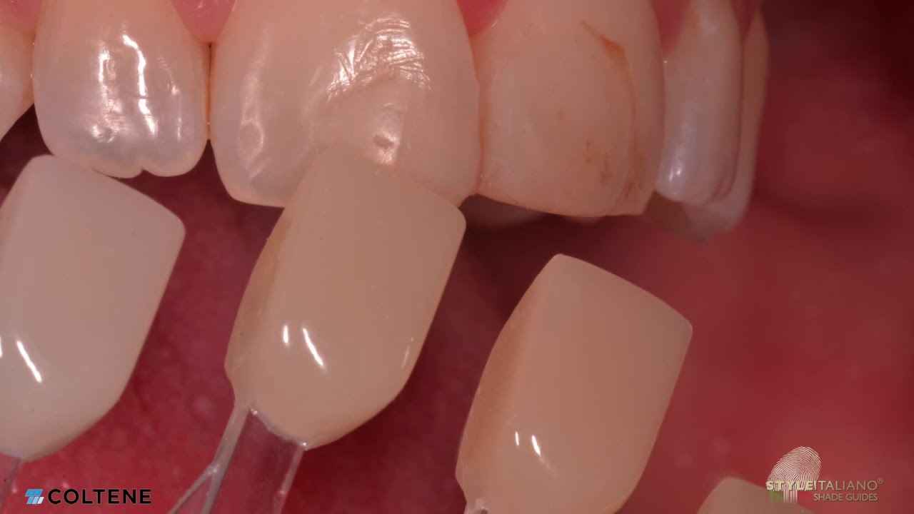 CCC - Monaldo Saracinelli StyleItaliano (Direct anterior single mass restoration) BRILLIANT EverGlow