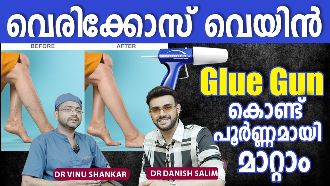 2225: വെരിക്കോസ് വെയ്ൻ – എളുപ്പത്തിൽ മാറ്റാം | Varicose Vein Easy Treatment