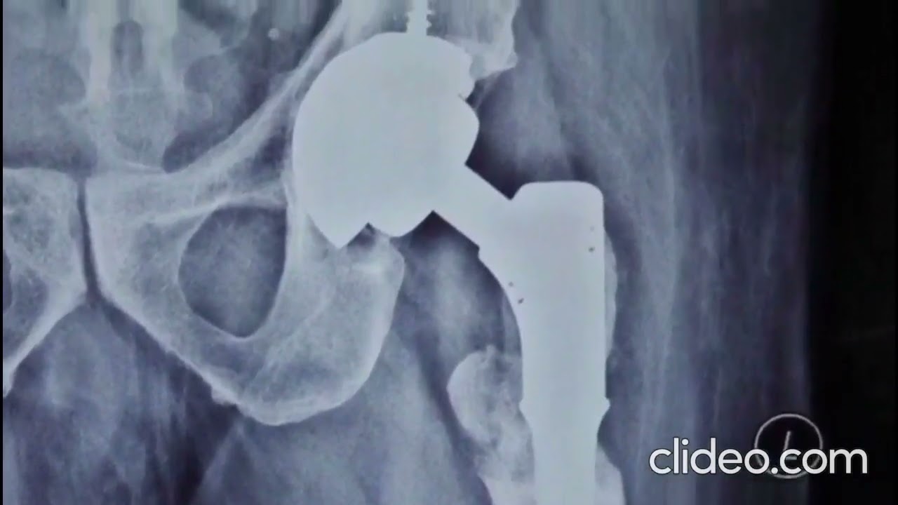 Proximal Femur Replacement