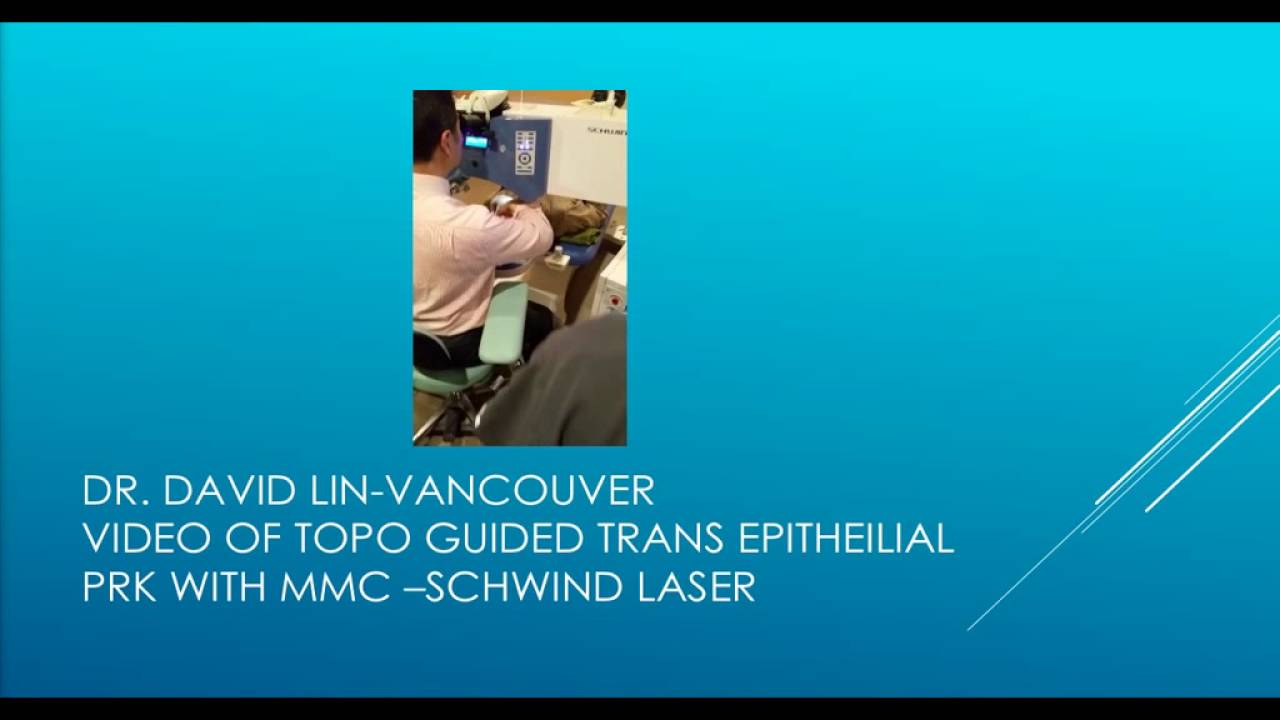 James Salz - Topography-Guided PRK for Irregular Astigmatism in my Left Eye