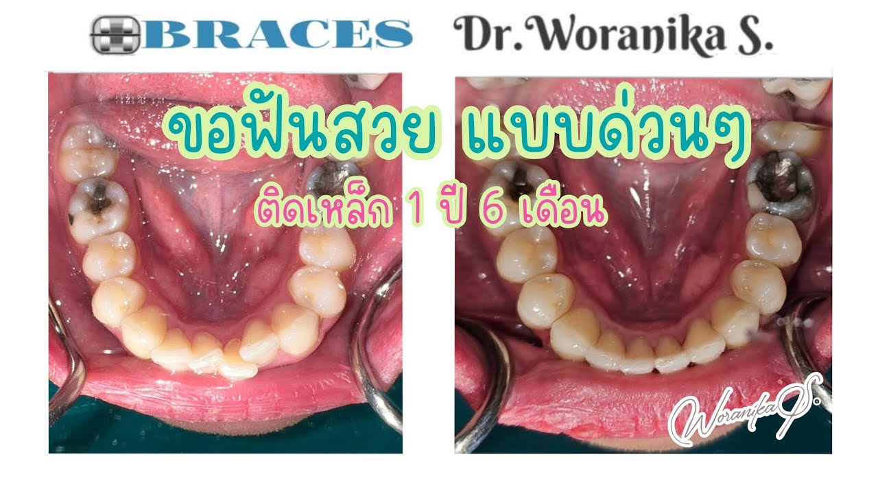หมอต่าย : คนไข้ขอฟันสวยแบบด่วนๆ โดยจัดฟันโลหะติดแน่น หมอต่ายจัดให้ค่าา 1 ปี 6 เดือน