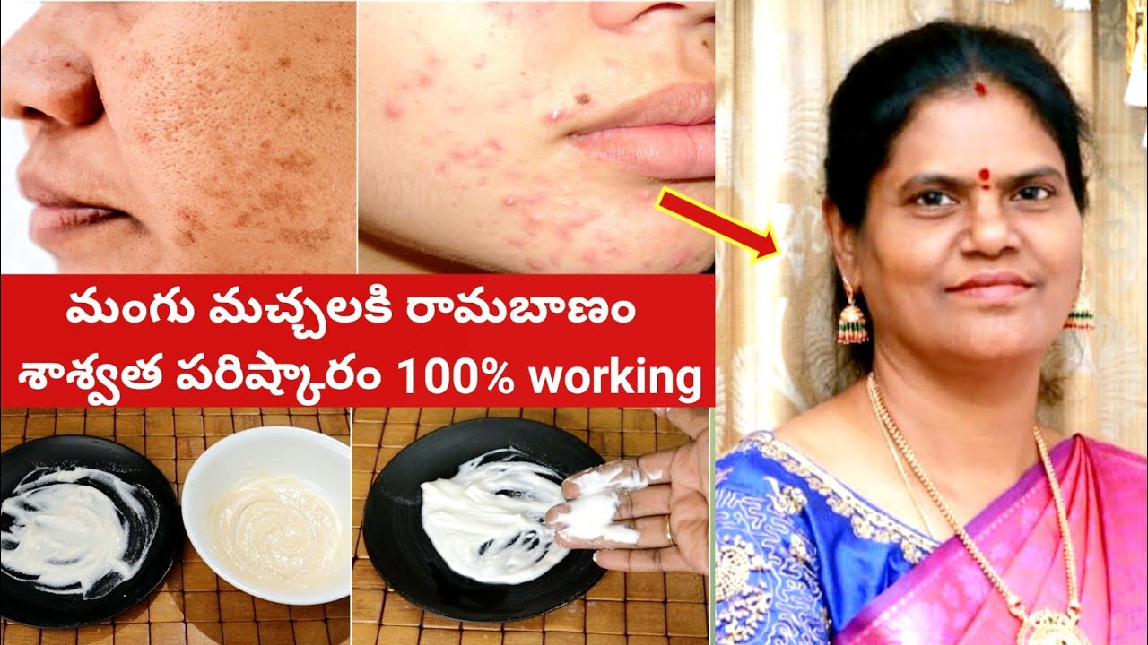 Pigmentation మంగు మచ్చలు Acne Scars నల్ల మచ్చలు 100% శాశ్వతంగా పోవాలంటే 👉 Remedy For Pigmentation
