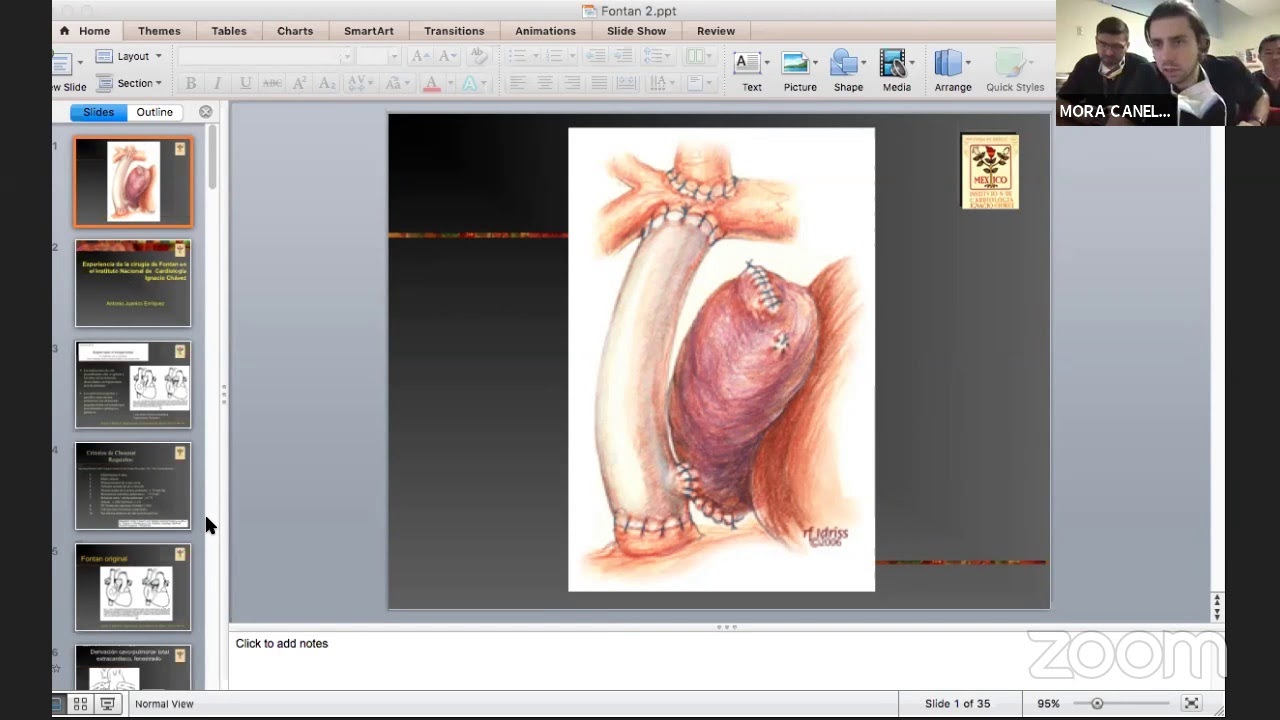 Atresia Tricuspidea