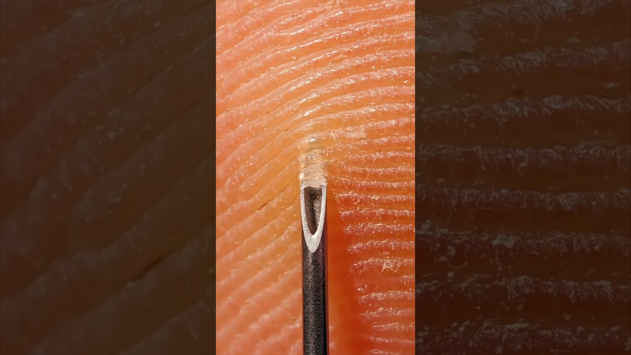 Needle stick injury visualized up close!  #microscope #anatomy #skincare #science #medical