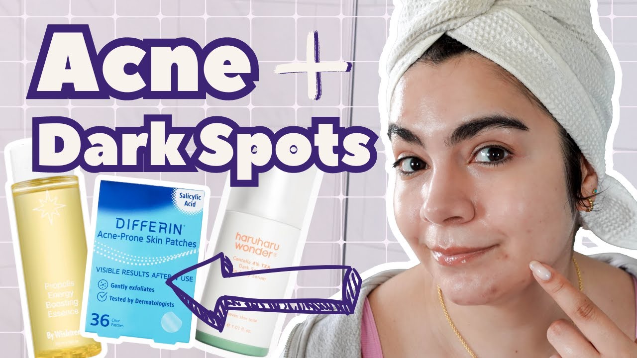 I'm Breaking Out! Routine for Breakouts and Hyperpigmentation