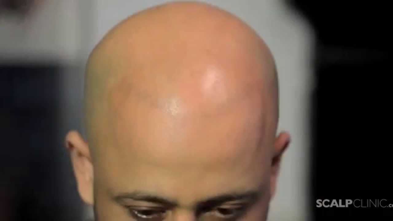 Scalp Micropigmentation for Asian Men - Hair Loss Treatment at Scalp Clinic (complete)