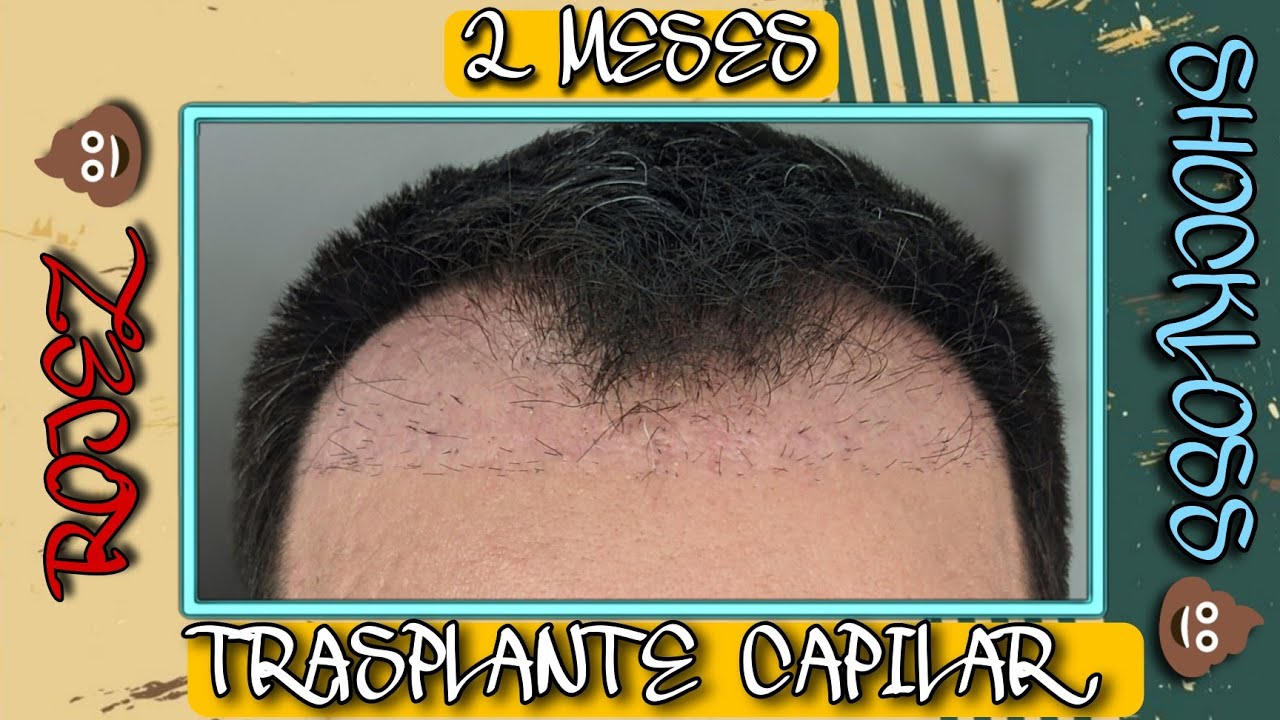 #18.- Evolución TRASPLANTE CAPILAR mes a mes/ MES 2