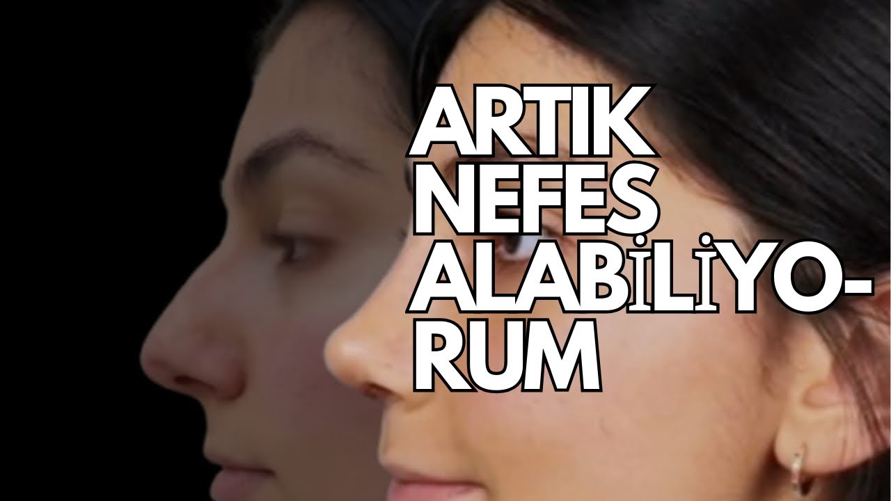 Nefes Alamayan Kemerli Burun: Doğallığı Bozmadan Değişim! (7. Gün Sonucu)