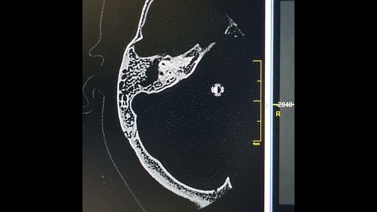 Right mastoiditis and suppurative otitis media.