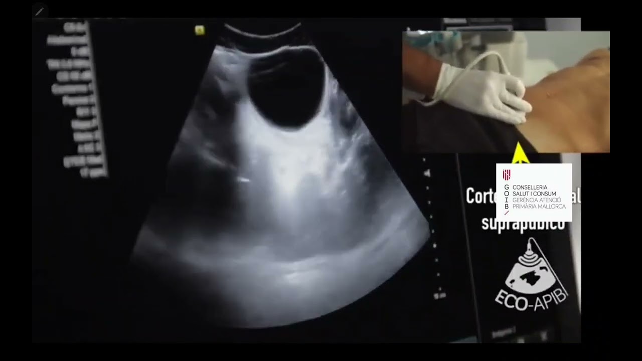 ECOGRAFÍA CLÍNICA ABDOMINAL EN EL DIA A DIA DE LA CONSULTA DEL MÉDICO DE FAMILIA POCUS Dr Estelrich.