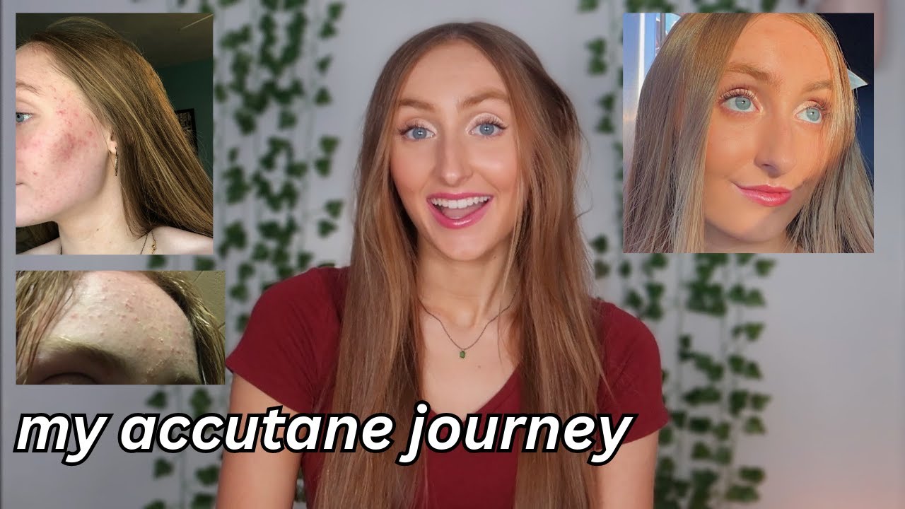 my accutane & skin journey (monthly updates)